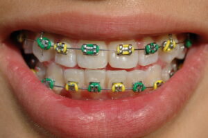 colorful braces of a smiling teenager